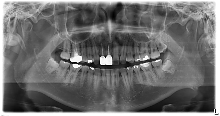 최종 보철물 세팅 후 파노라마 X-ray 사진