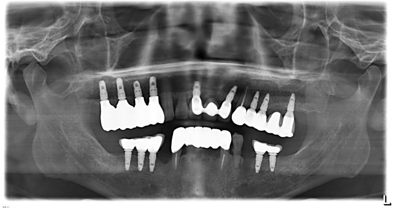 모든 치료가 마무리된 후 촬영한 최종 파노라마 X-ray 사진입니다. 임플란트와 브릿지가 안정적으로 자리 잡은 것을 확인할 수 있습니다.