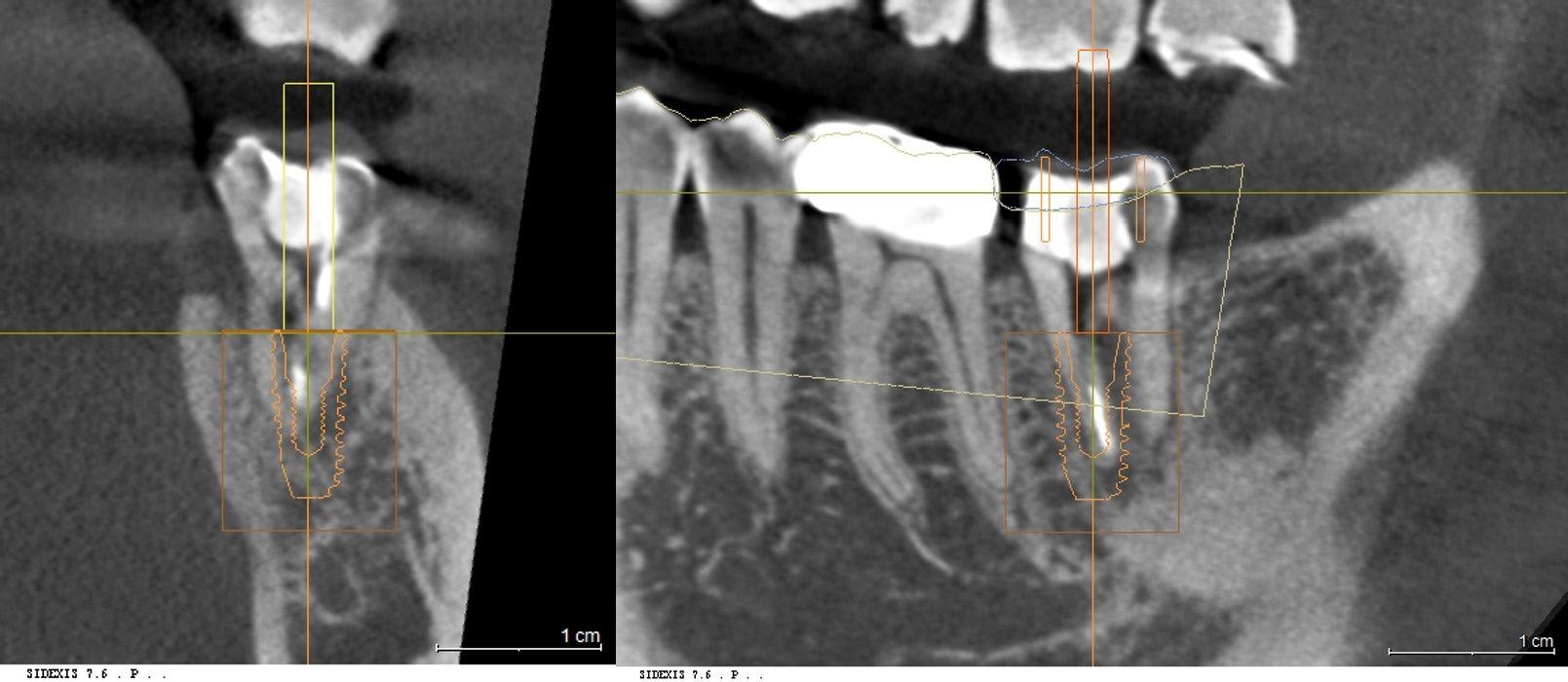 3D CT 데이터와 구강 스캔을 정합한 컴퓨터 가상 모의수술 계획 화면