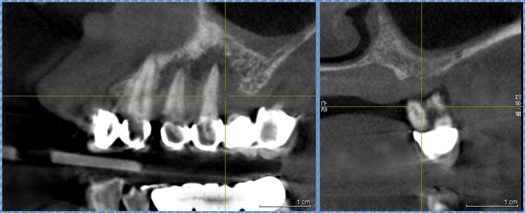 치료 전 구강 내 3D CT 단면: 상악 좌측 어금니 치근 주변의 심각한 치조골 소실 확인
