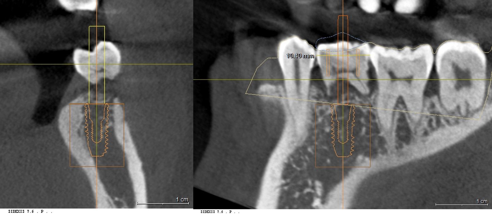 3D CT 단면 영상 및 컴퓨터 모의수술을 통한 골밀도·치아 간격 분석