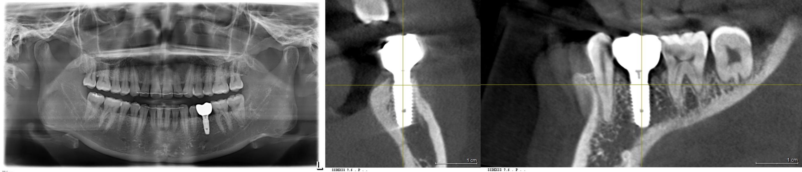 식립 후 경과 확인 엑스레이, 구강스캔 CAD/CAM 디자인, 최종 보철 장착