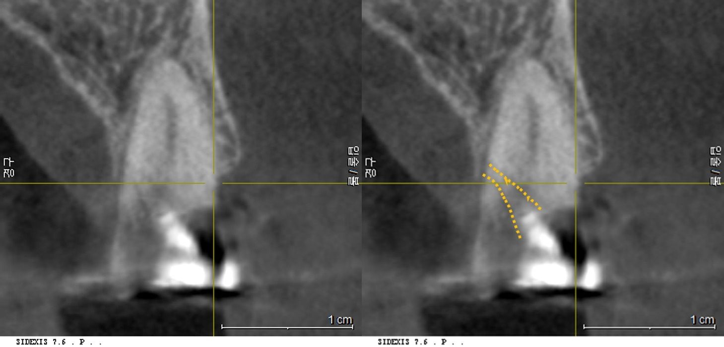 3D CT 단면 영상을 통해 치조골 하방으로 이어진 파절선(노란 선) 확인