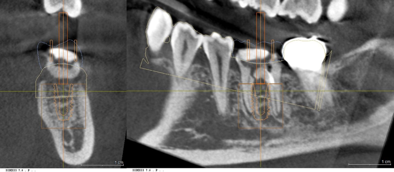 3D CT 및 구강 스캔 데이터를 결합한 네비게이션 모의 식립 분석