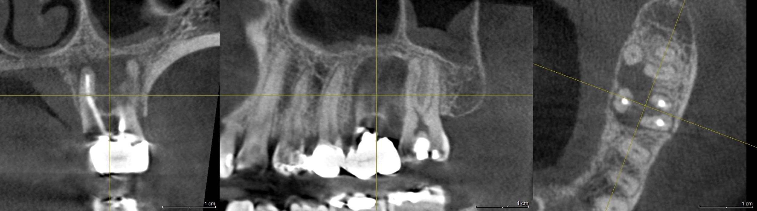 정밀 진단을 위한 파노라마 X-ray 및 3D CT 단면 영상 (치근단 염증 및 골 흡수 확인)