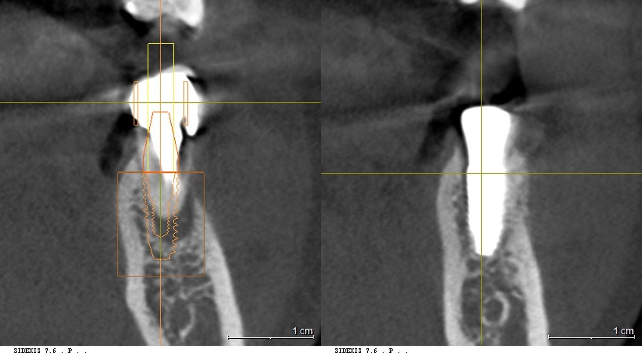 수술 전 CT(좌측: 치근단 뼈 소실)와 수술 직후 CT(우측: 뼈이식 및 안정적인 식립 확인)