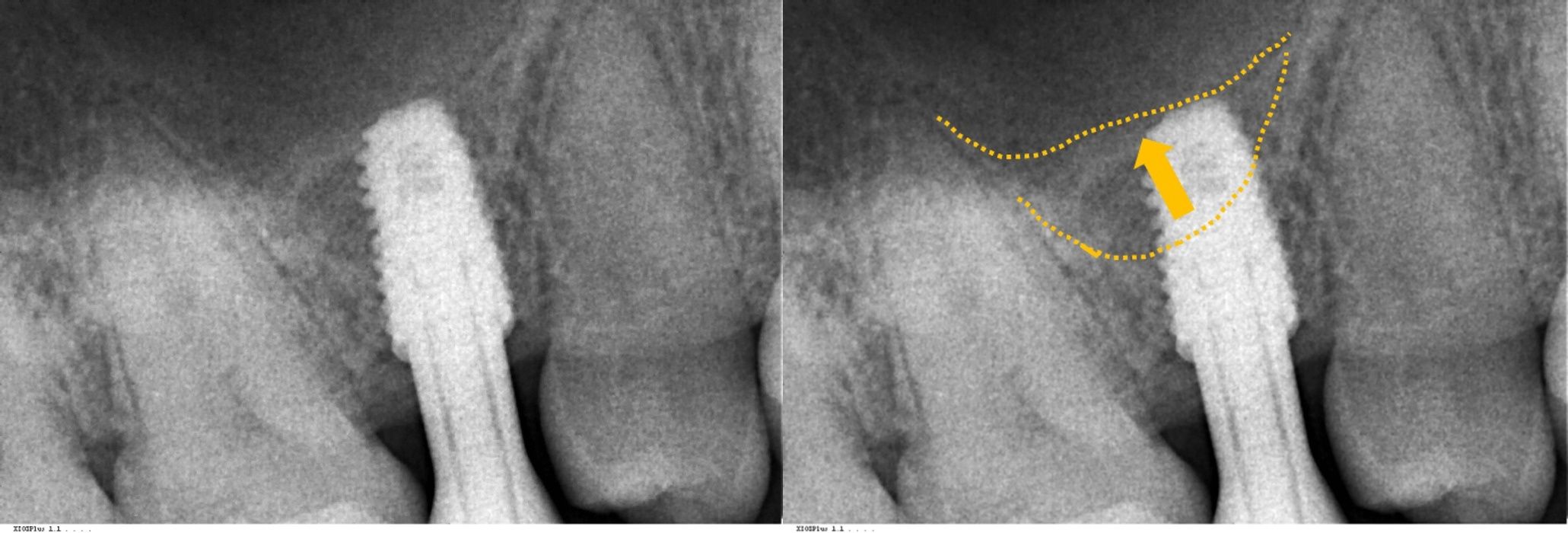 수술 직후 촬영한 X-ray 및 CT 영상: 상악동 내부 PRF 충전 및 픽스처 식립