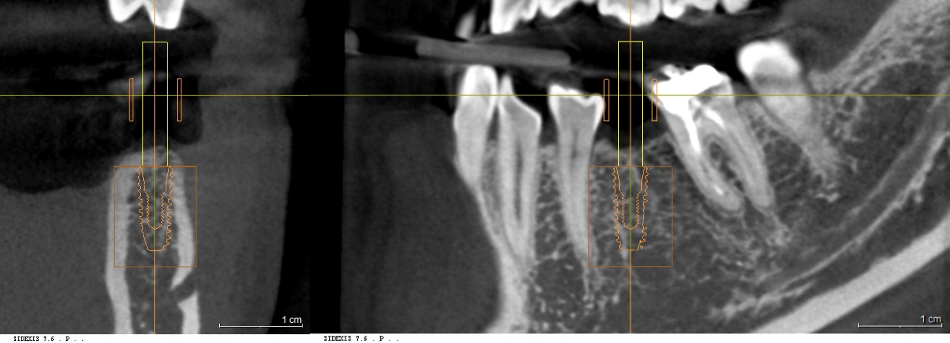 3D CT 정밀 진단 및 원내기공실 모의수술 데이터