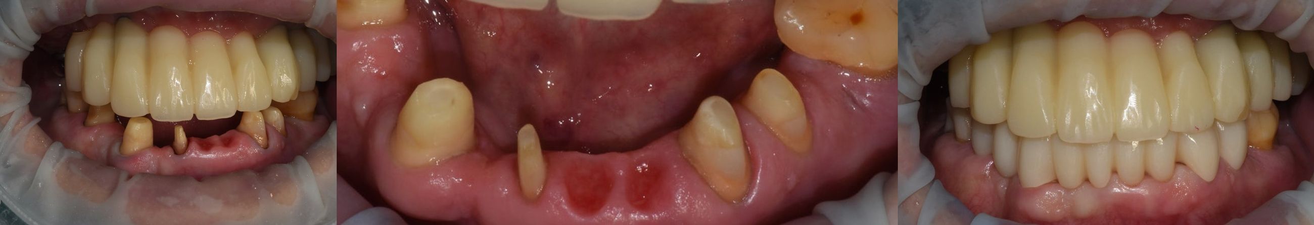 하악 잇몸 형태에 맞춘 오베이트 폰틱(Ovate Pontic) 디자인 적용 과정