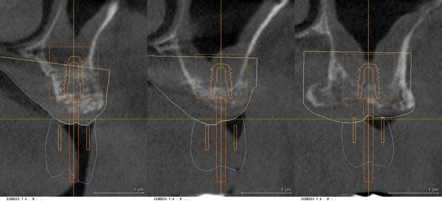 좌측 구치부 3D CT 및 모의수술 분석 데이터