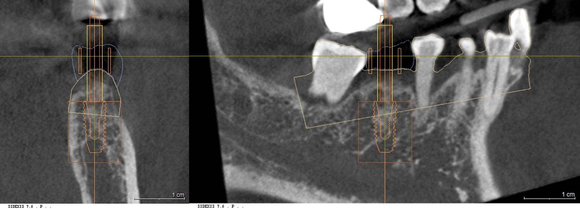 3D CT 데이터를 통한 하치조 신경관 경로 및 골 형태 정밀 분석
