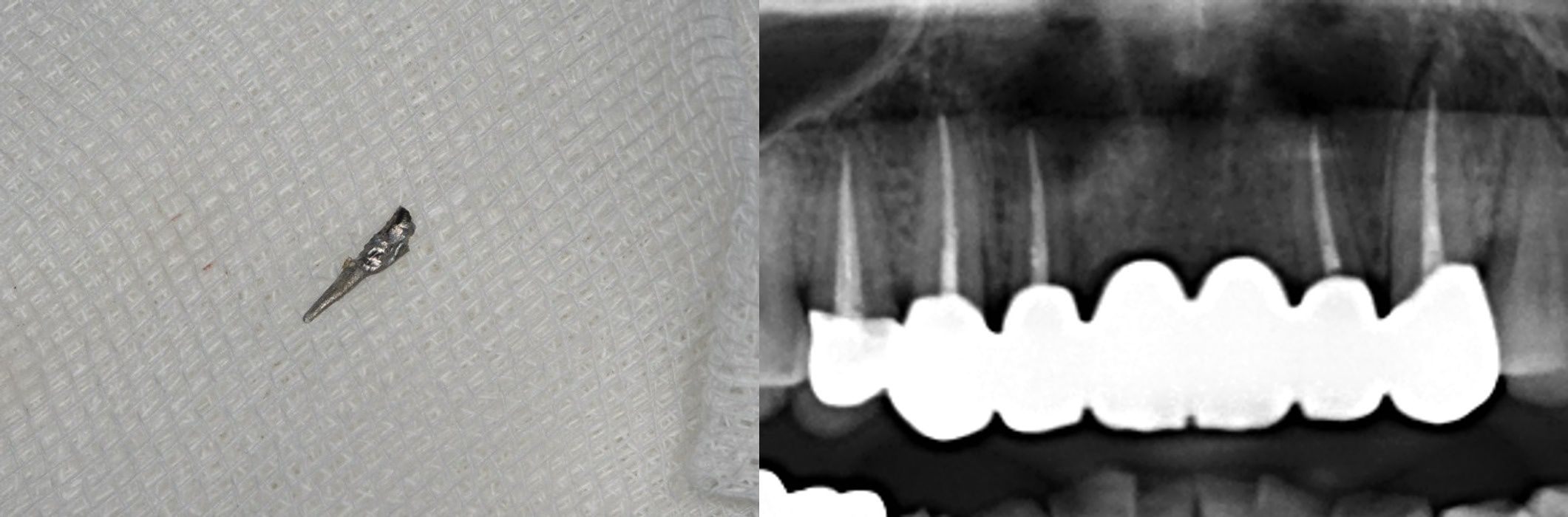 뿌리 끝까지 흰색 신경치료 물질이 치밀하게 채워진 경과 X-ray 사진