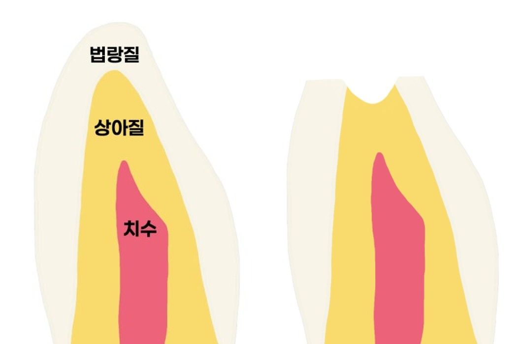 분화구 형태로 깊어지는 치아 마모의 진행 양상 모식도