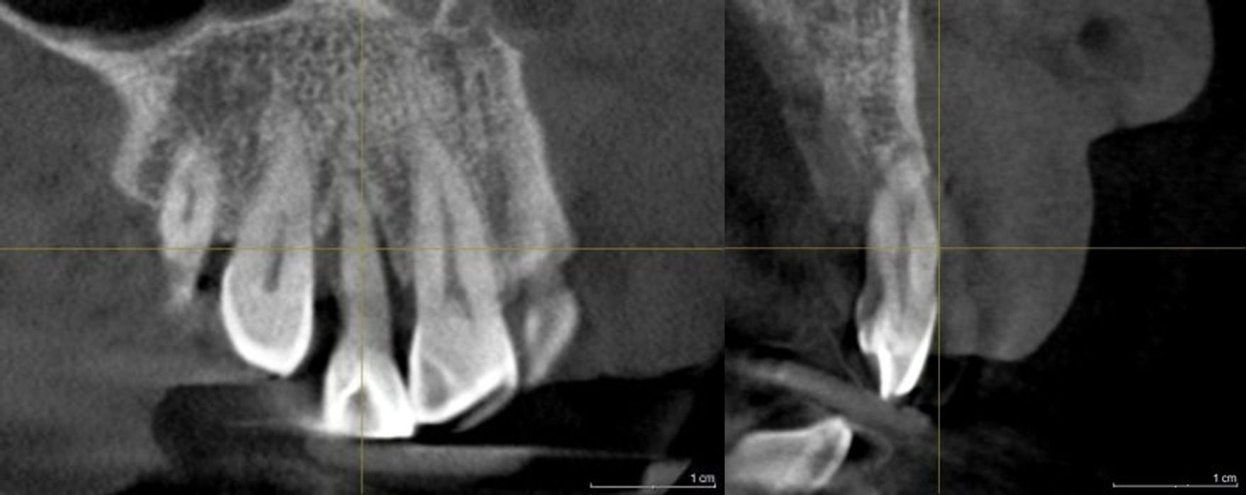 3D CT 및 방사선 정밀 검사를 통해 확인한 측절치 주변 치조골 흡수 양상