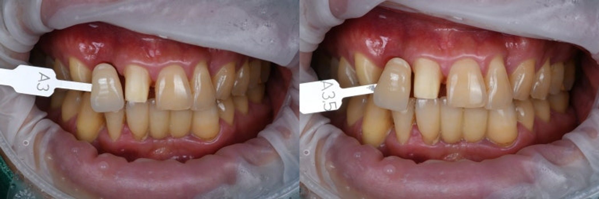 디지털 구강스캔과 정밀 아날로그 인상채득 과정을 함께 적용하는 장면