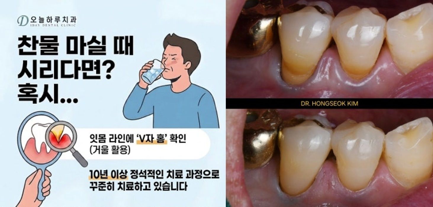 치경부마모증 정밀 진단 구강 소견 (2023. 7. 24)