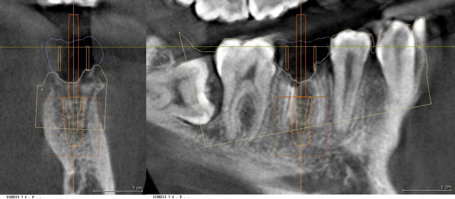 우측 하악 파절 어금니 부위의 3D CT 단면 분석 및 식립 경로 계획