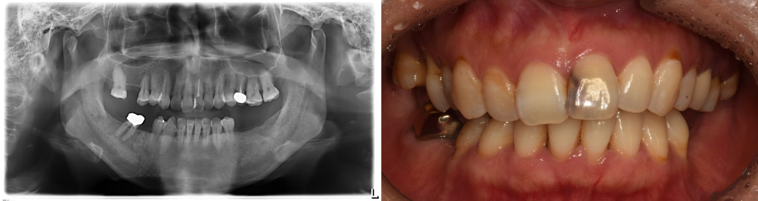내원 당시 앞니 변색 상태와 어금니 결손을 확인한 구강 사진 및 파노라마 X-ray