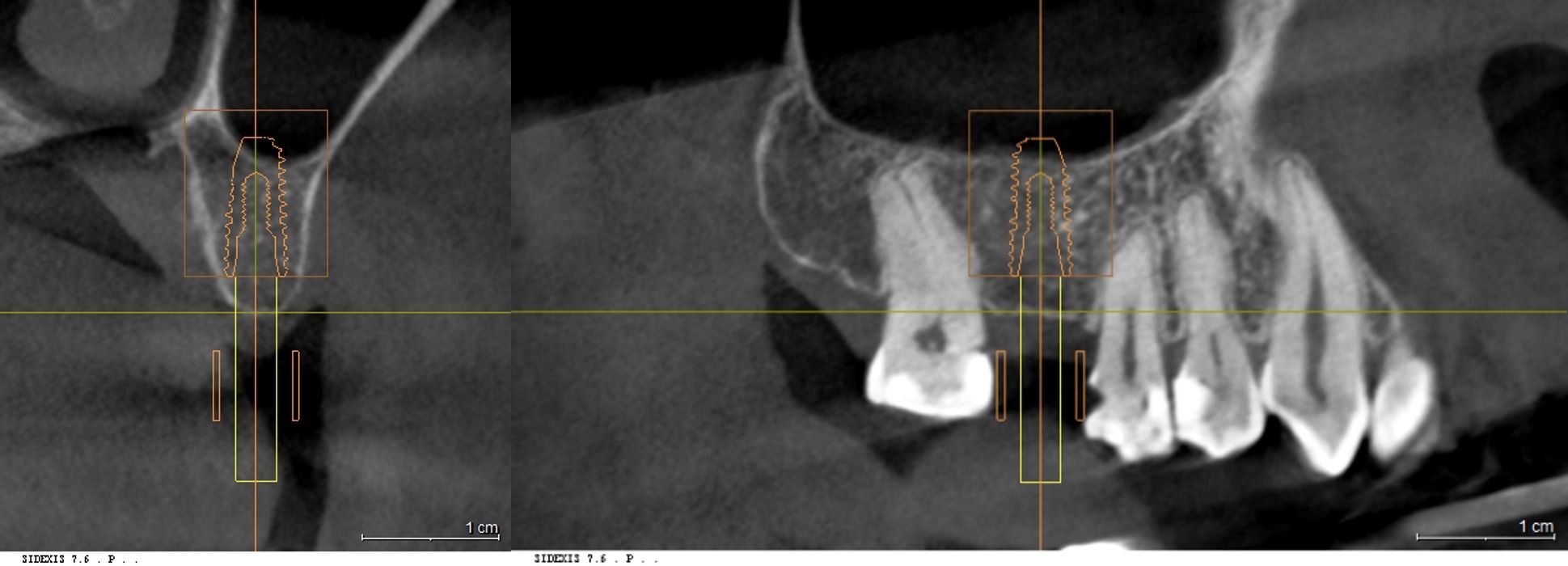 상악 우측 결손 부위의 3D CT 단면 분석 및 수술 가이드 모의수술 화면