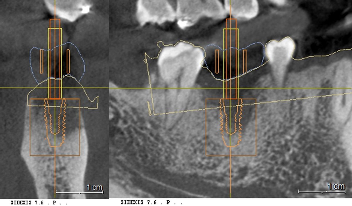 3D CT 단면 영상을 통한 치조골 밀도 측정 및 디지털 네비게이션 식립 모의 계획