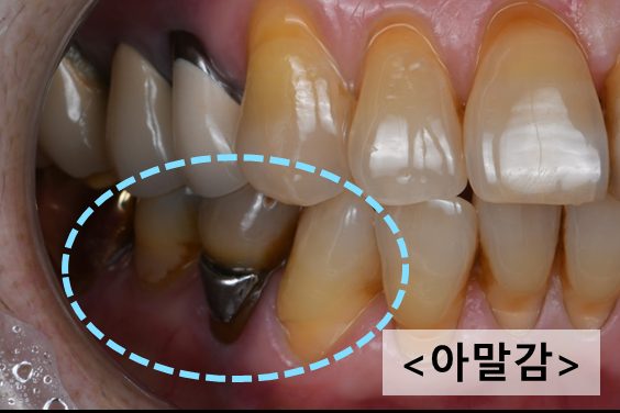 아말감으로 치료한 치아 목