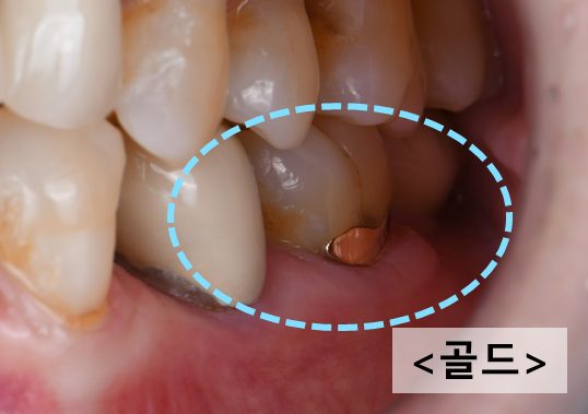 골드로 치료한 치아 목