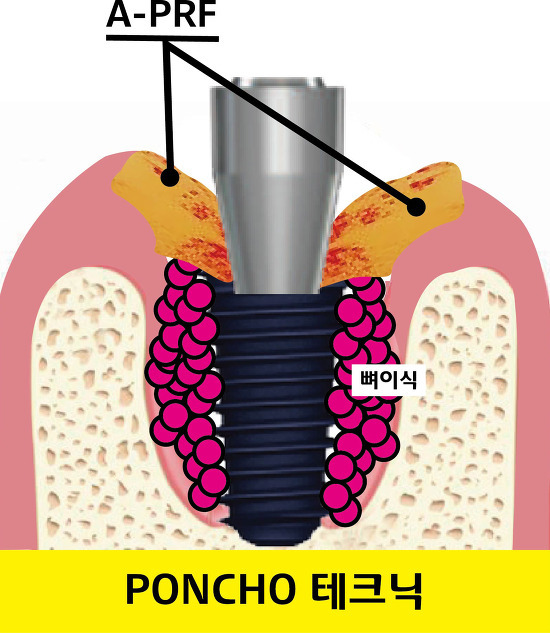 결합조직 이식