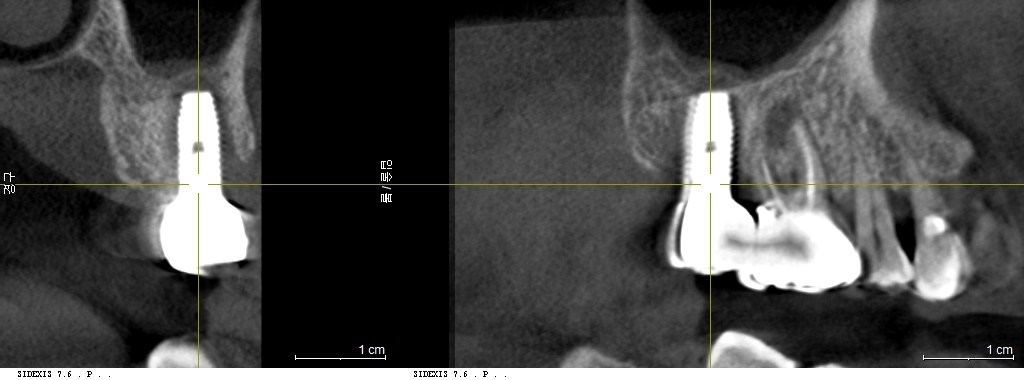 실제 재수술 증례의 3D CT 비교